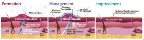 Silicone Scar Treatment Products